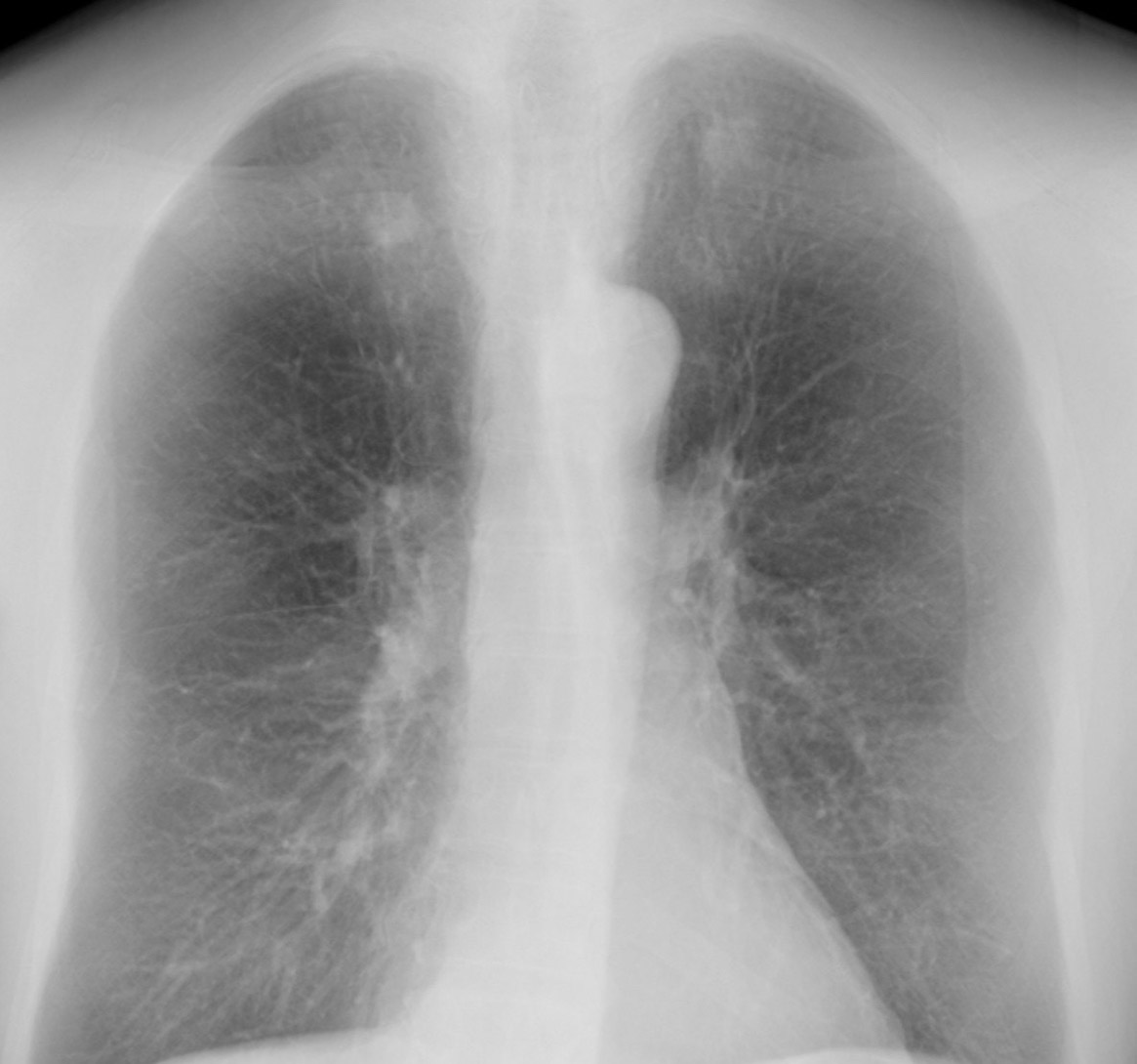 Riverain ClearRead Xray image with rib structure suppressed