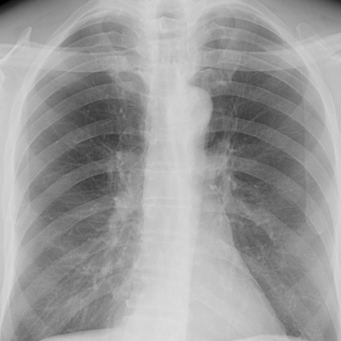 RIverain Xray Scan - "Before" Image showing ribs obstructing view