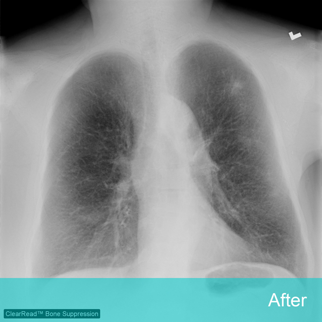 Lung Xray labeled 