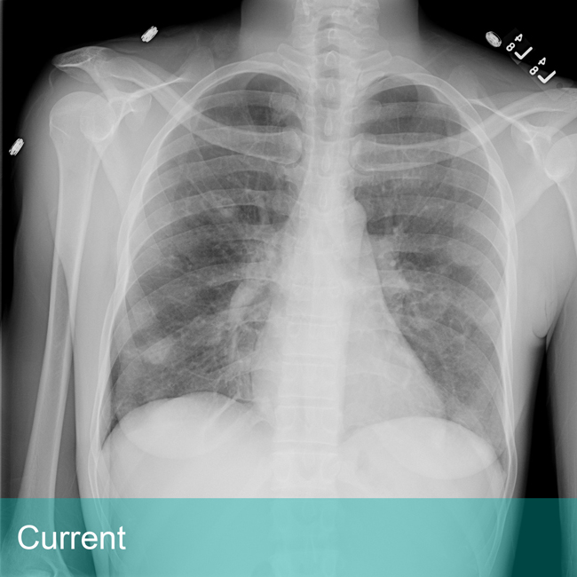 Lung Xray labeled - Current
