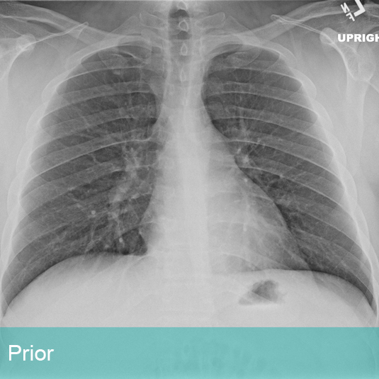 Lung Xray labeled Prior