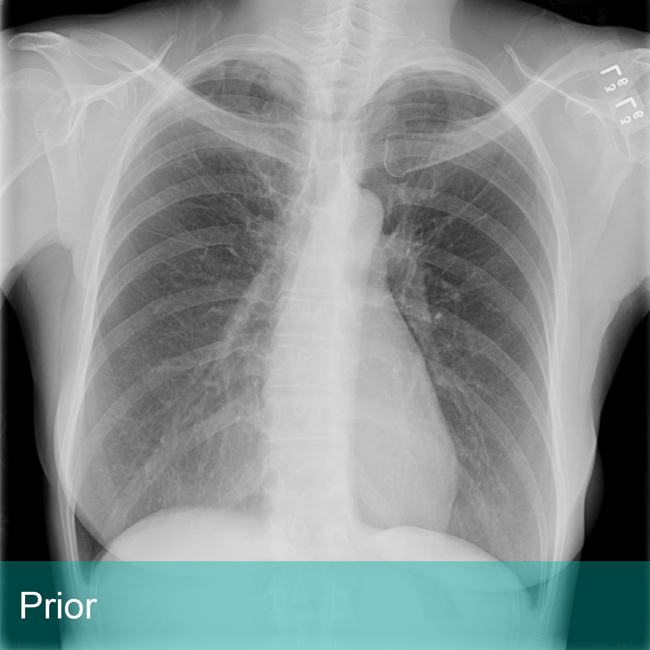 Lung Xray labeled Prior