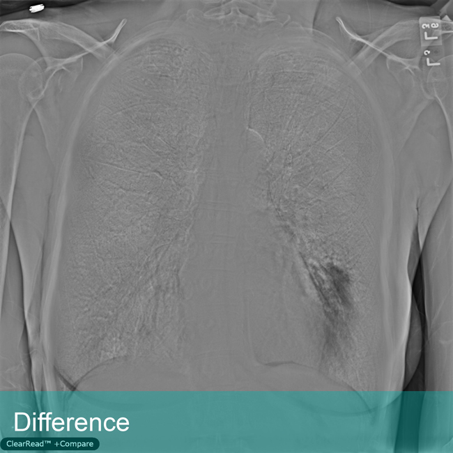 Lung Xray labeled Difference