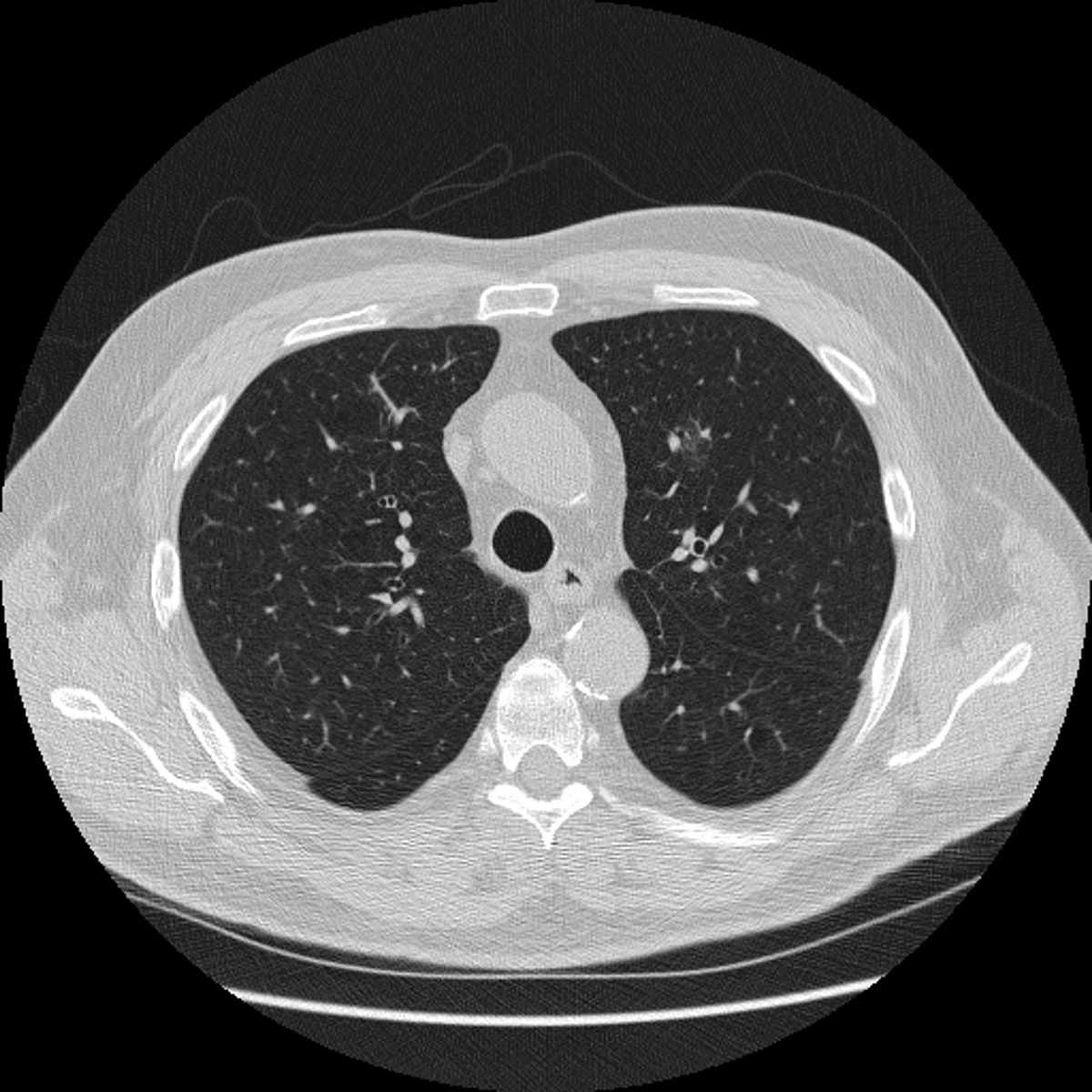 Typical CT scan that shows vessels