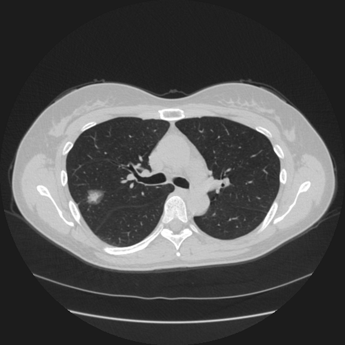 Image of nodule detected in CT scan