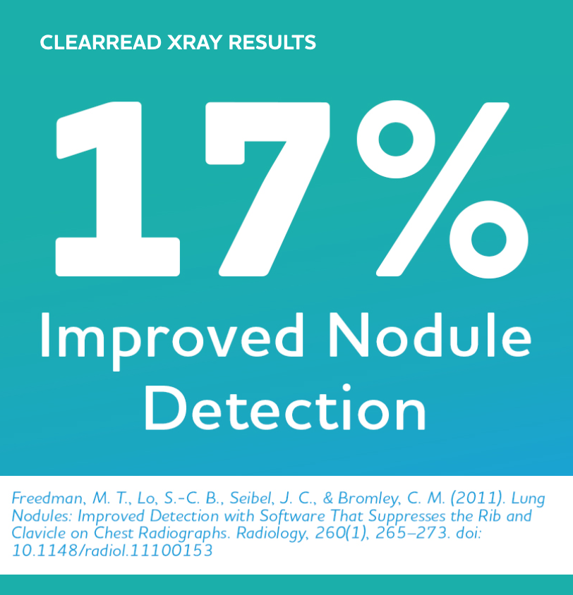 Graphic: 17% improved nodule detection