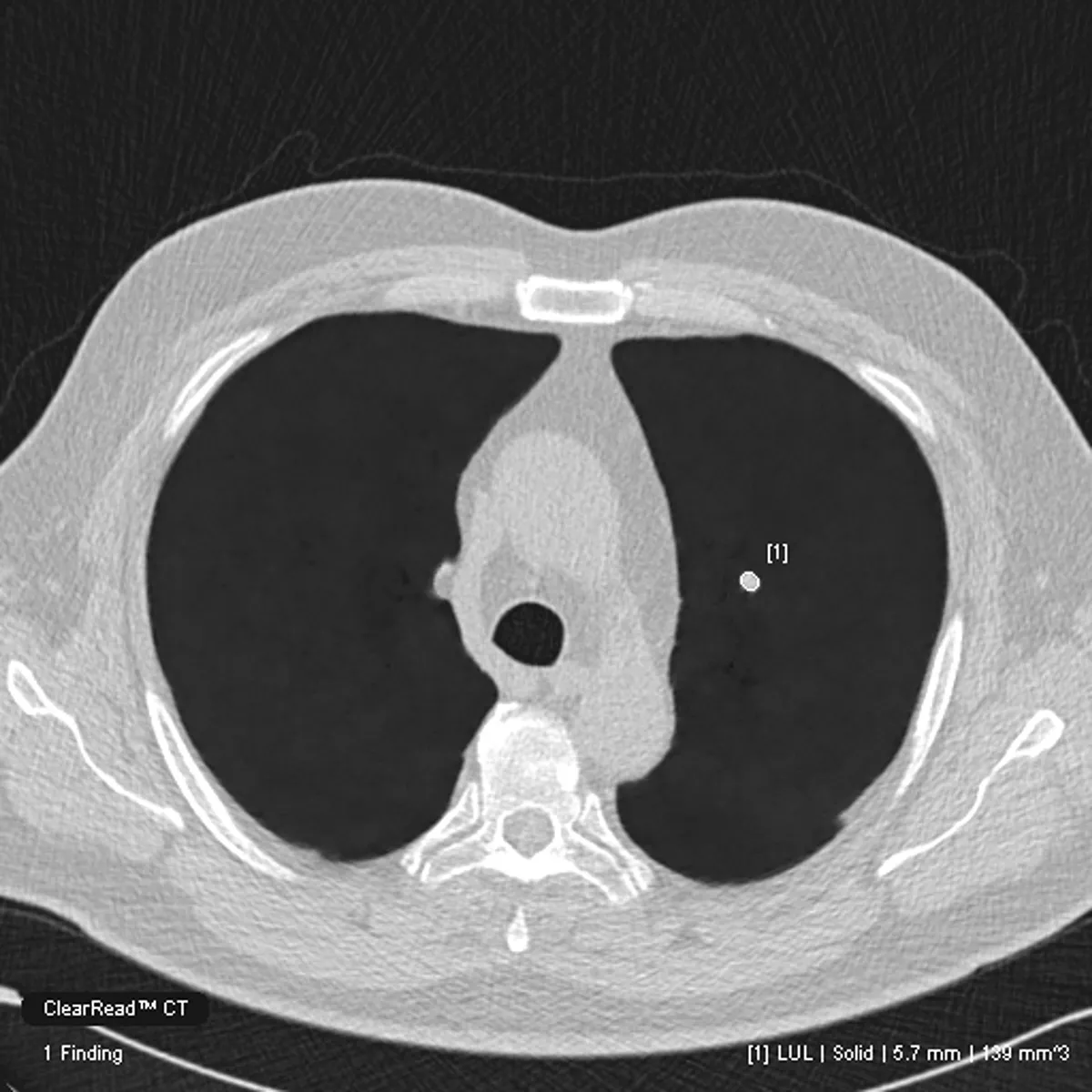 Image of nodule detected in CT scan