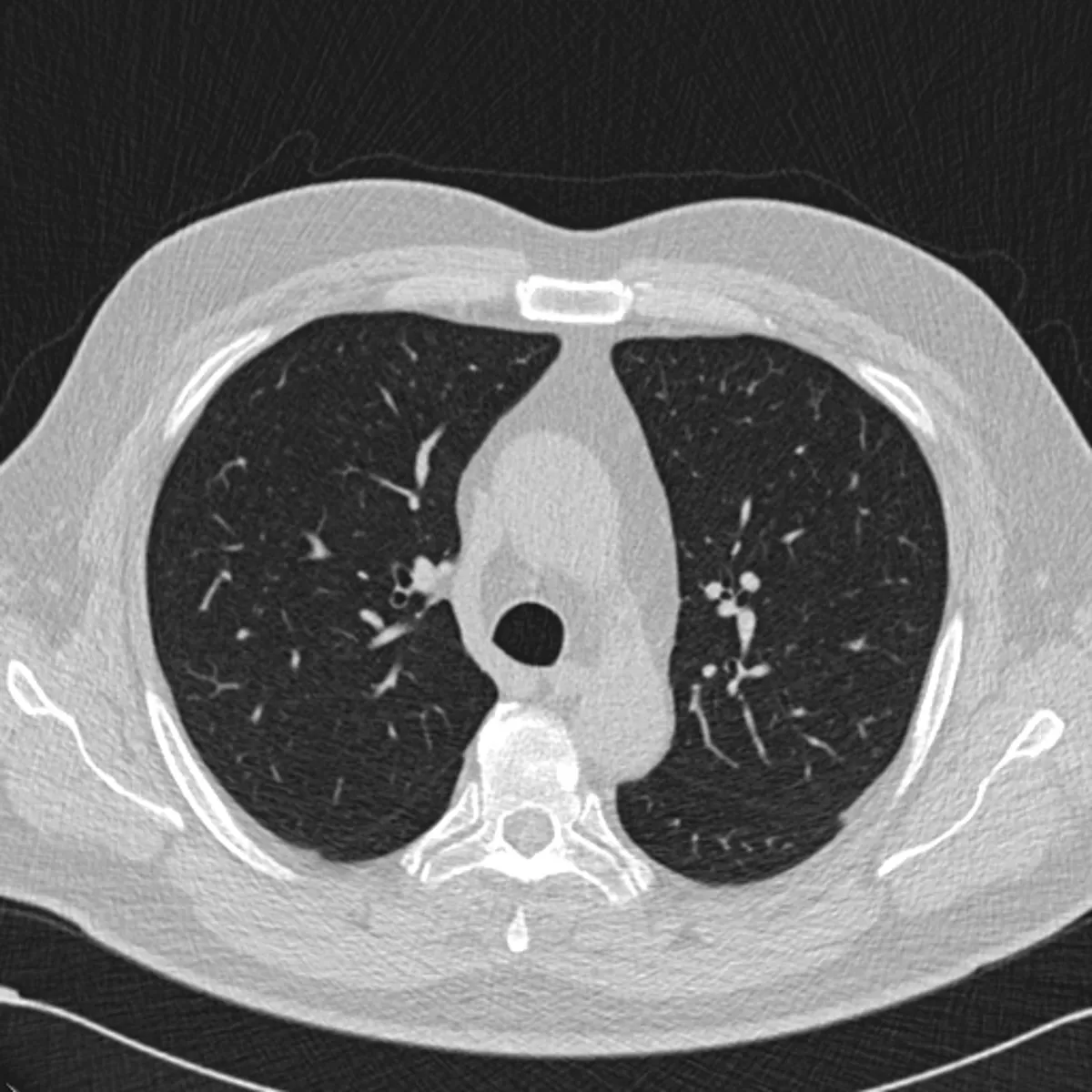 Typical CT scan that shows vessels