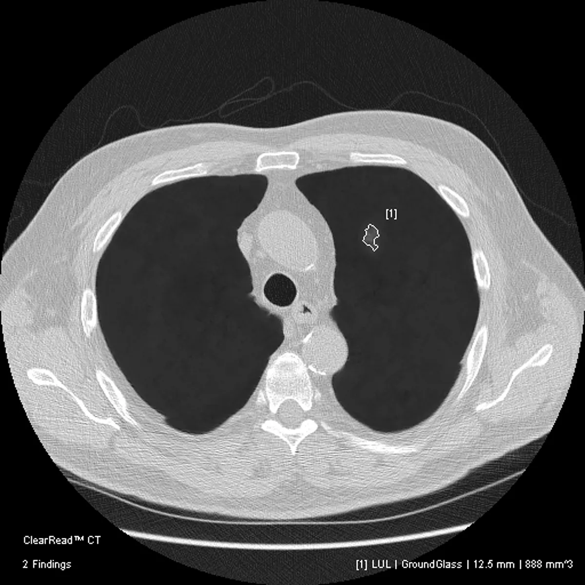 Image of nodule detected in CT scan