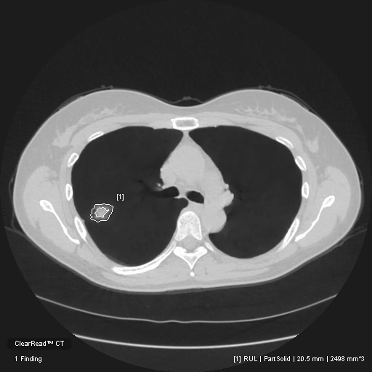 Image of nodule detected in CT scan