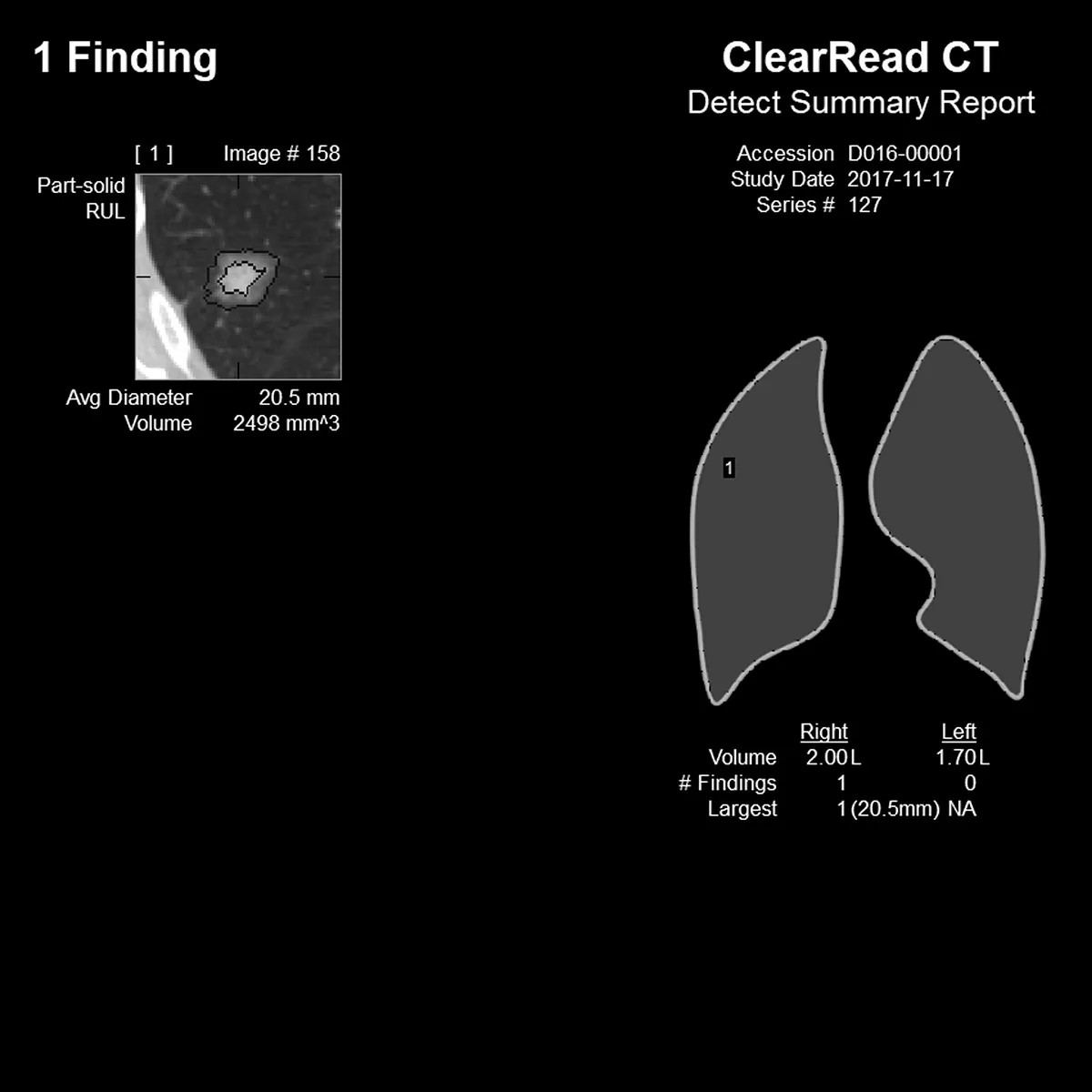 Two images from a Riverain CT scan