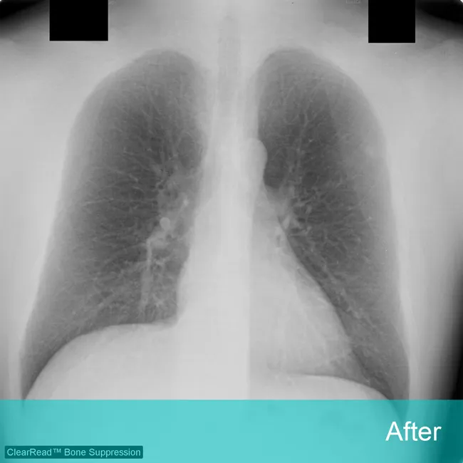 Lung Xray labeled 