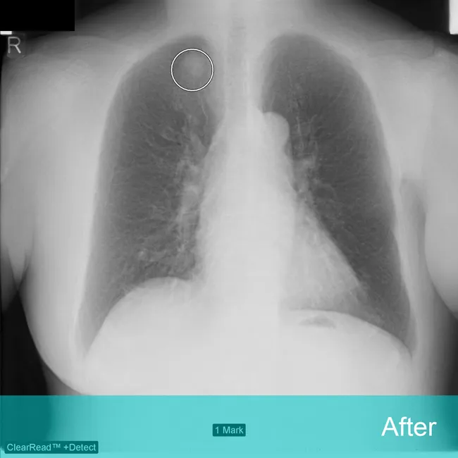 Demonstration that shows how Riverain ClearRead Xray elminates bone structure from view