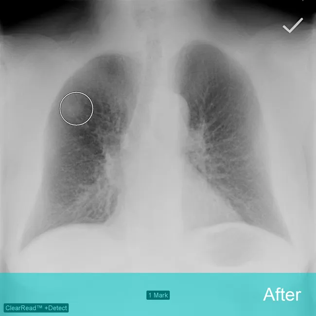 Circle on lung Xray shows nodule