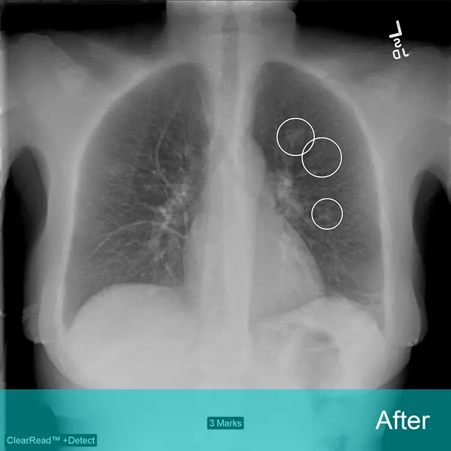 Image of Riverain ClearRead Xray with circles identifying nodules