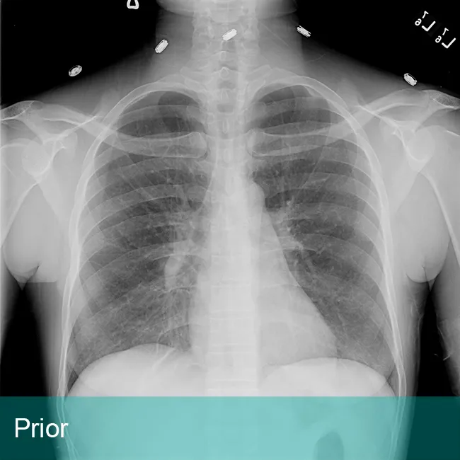 Lung Xray labeled prior