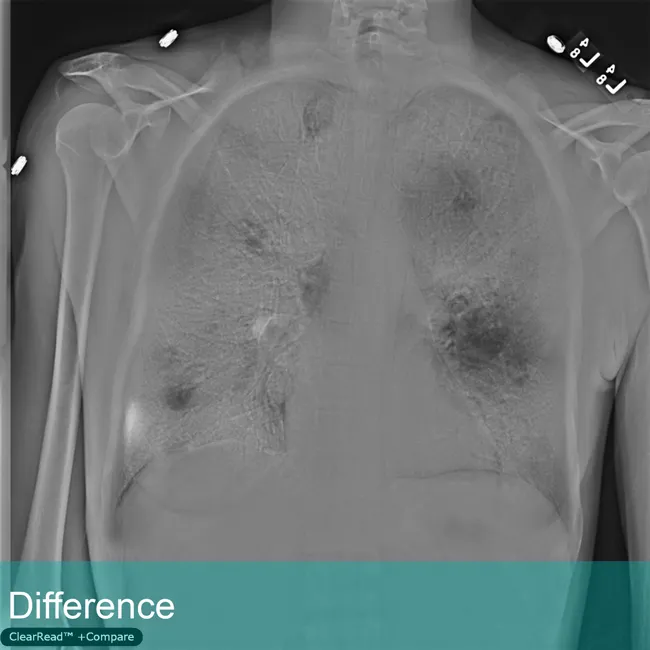 Lung Xray labeled Difference