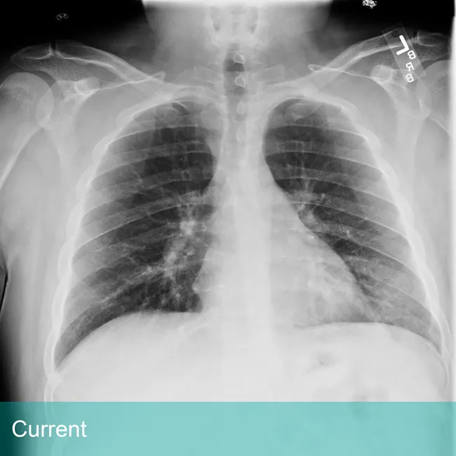 Lung Xray labeled Current