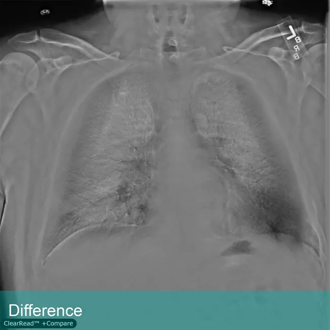 Lung Xray labeled Difference