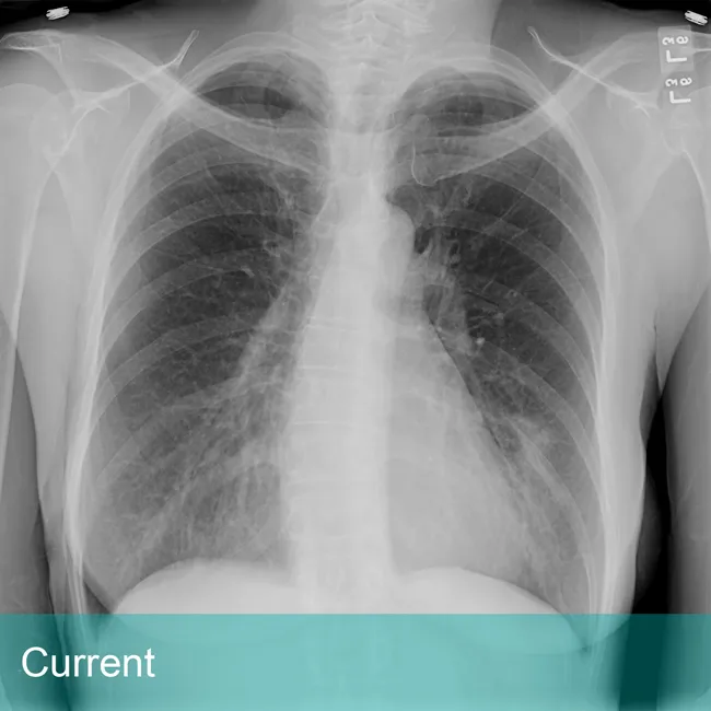 Lung Xray labeled Current