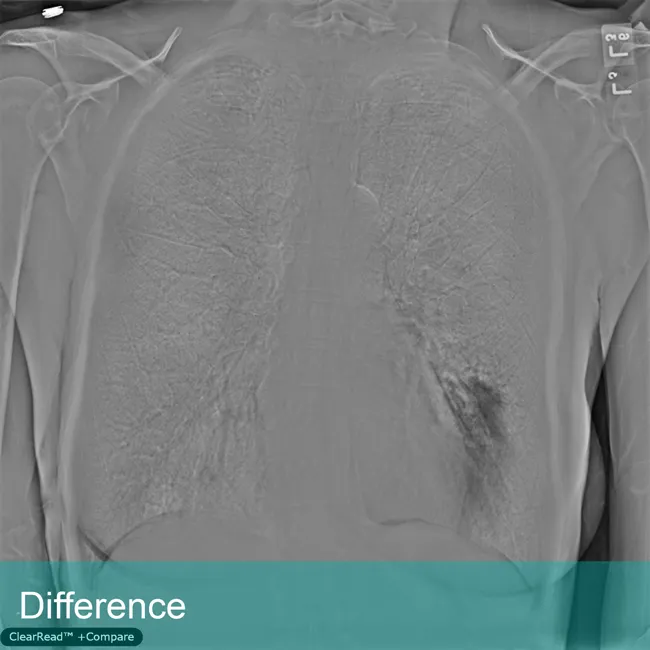 Lung Xray labeled Difference