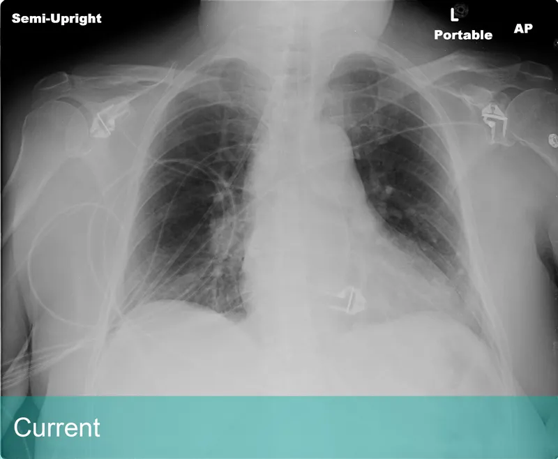 Lung Xray labeled - Current