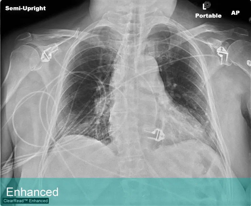 Lung Xray labeled - Enhanced