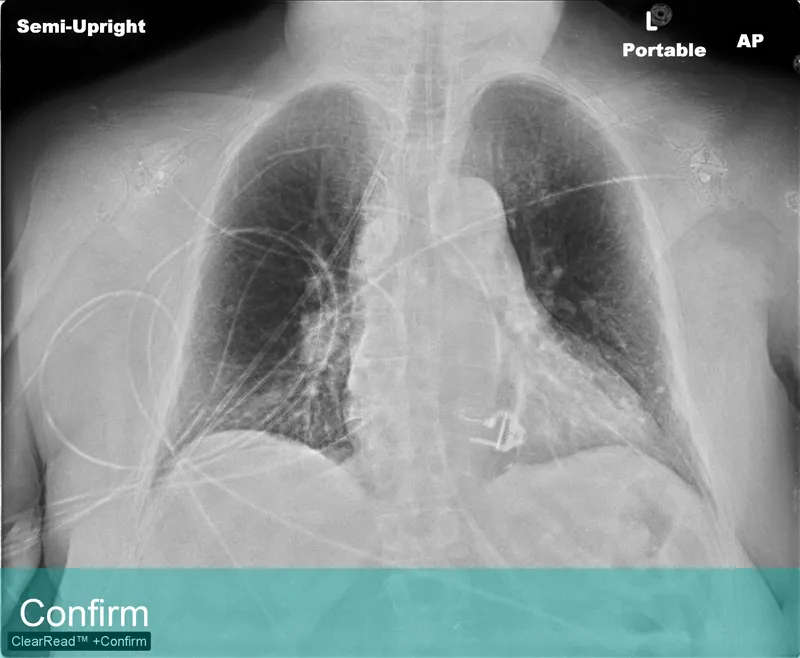 Lung Xray labeled - Confirm