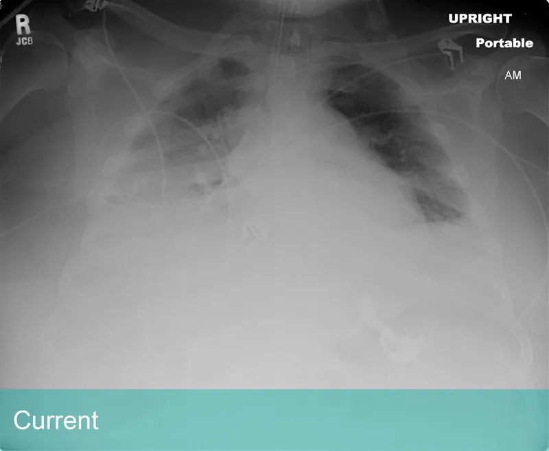 Lung Xray labeled Current