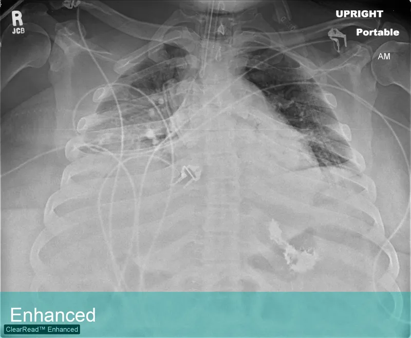 Lung Xray labeled Enhanced