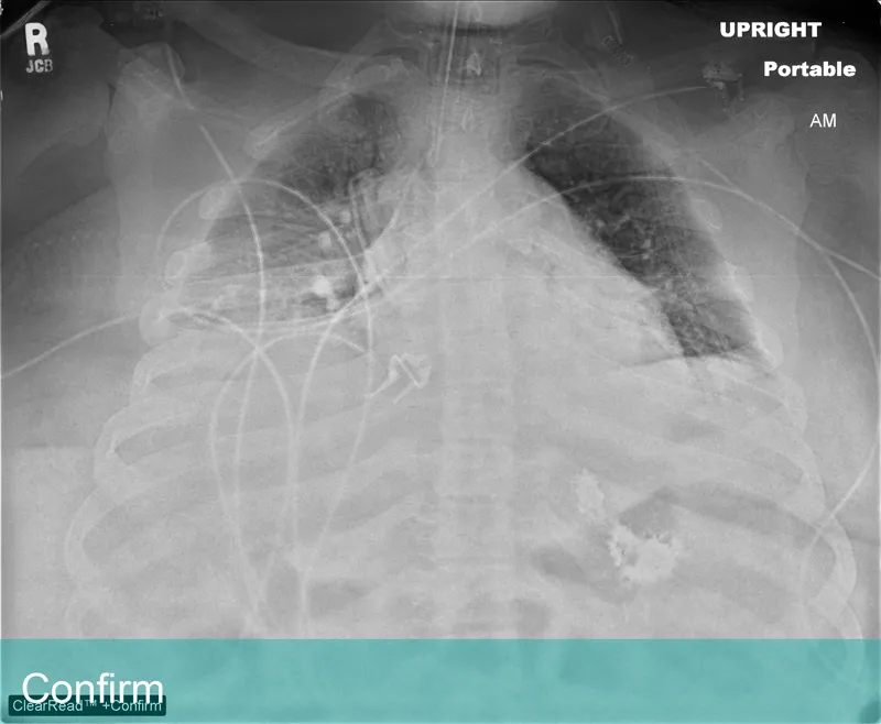 Lung Xray labeled Confirm