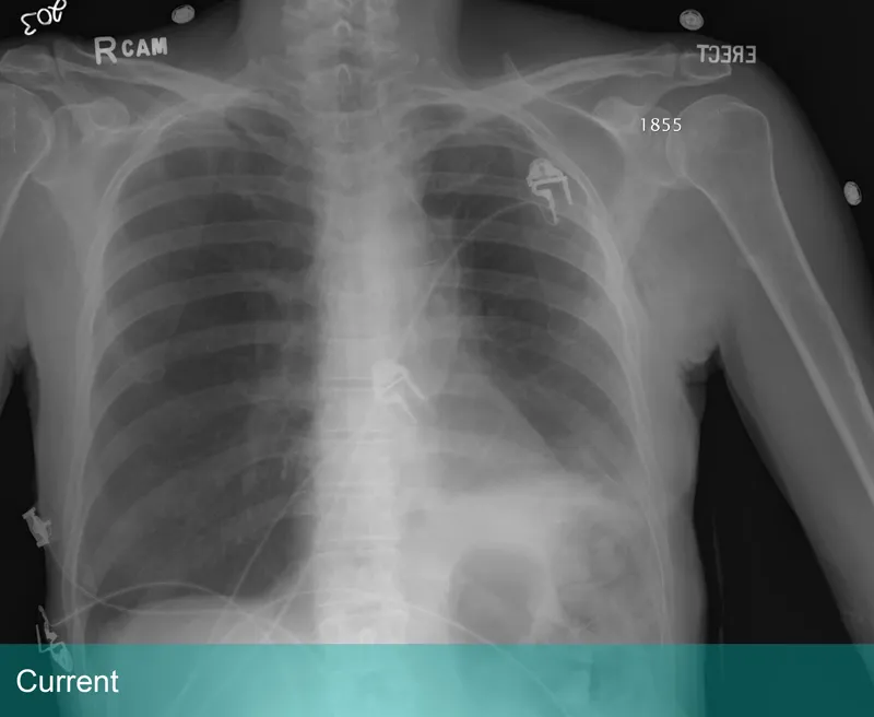 Lung Xray labeled Current