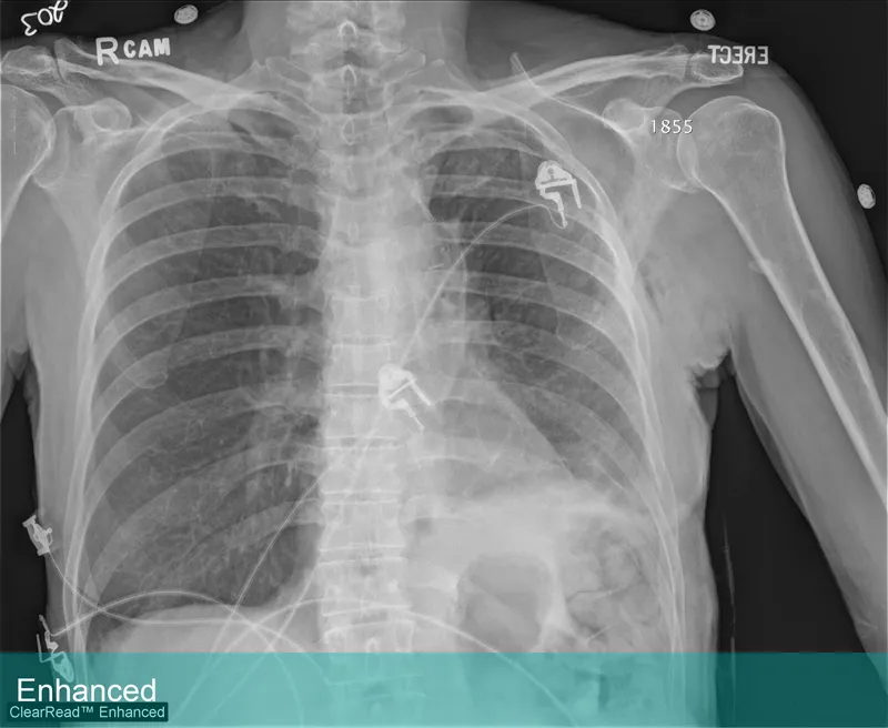 Lung Xray labeled Enhanced