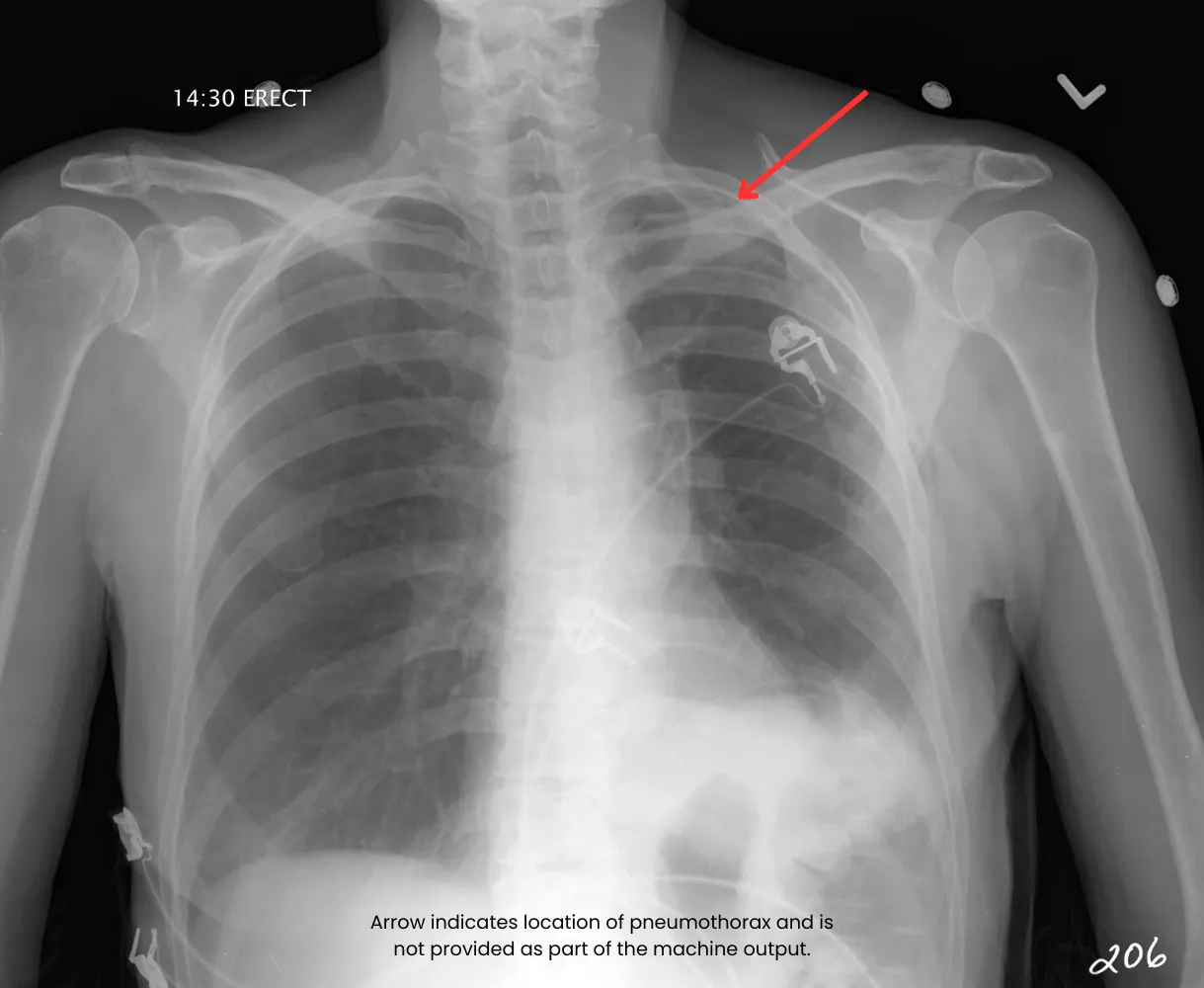 ClearRead Xray Pneumothorax diagnosis