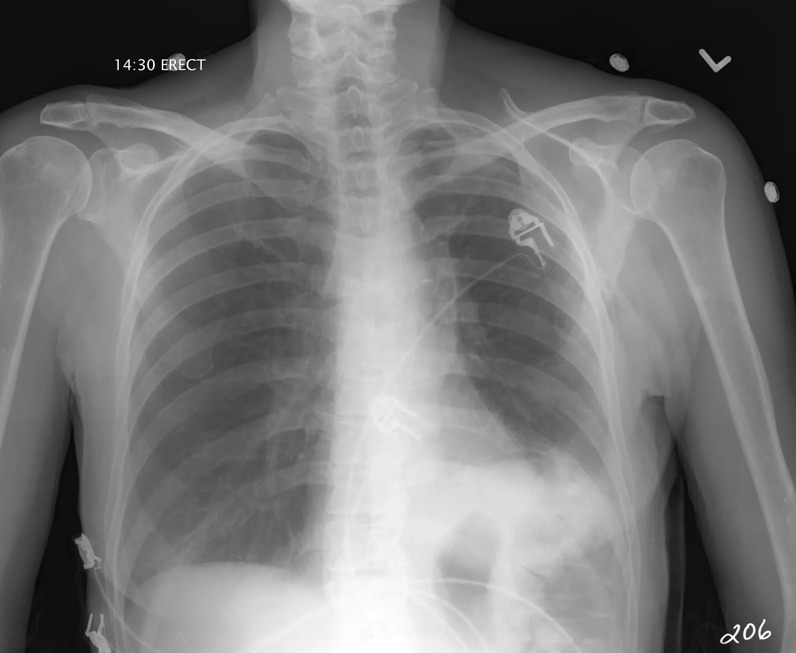 chest x-ray with pneumothorax diagnosis