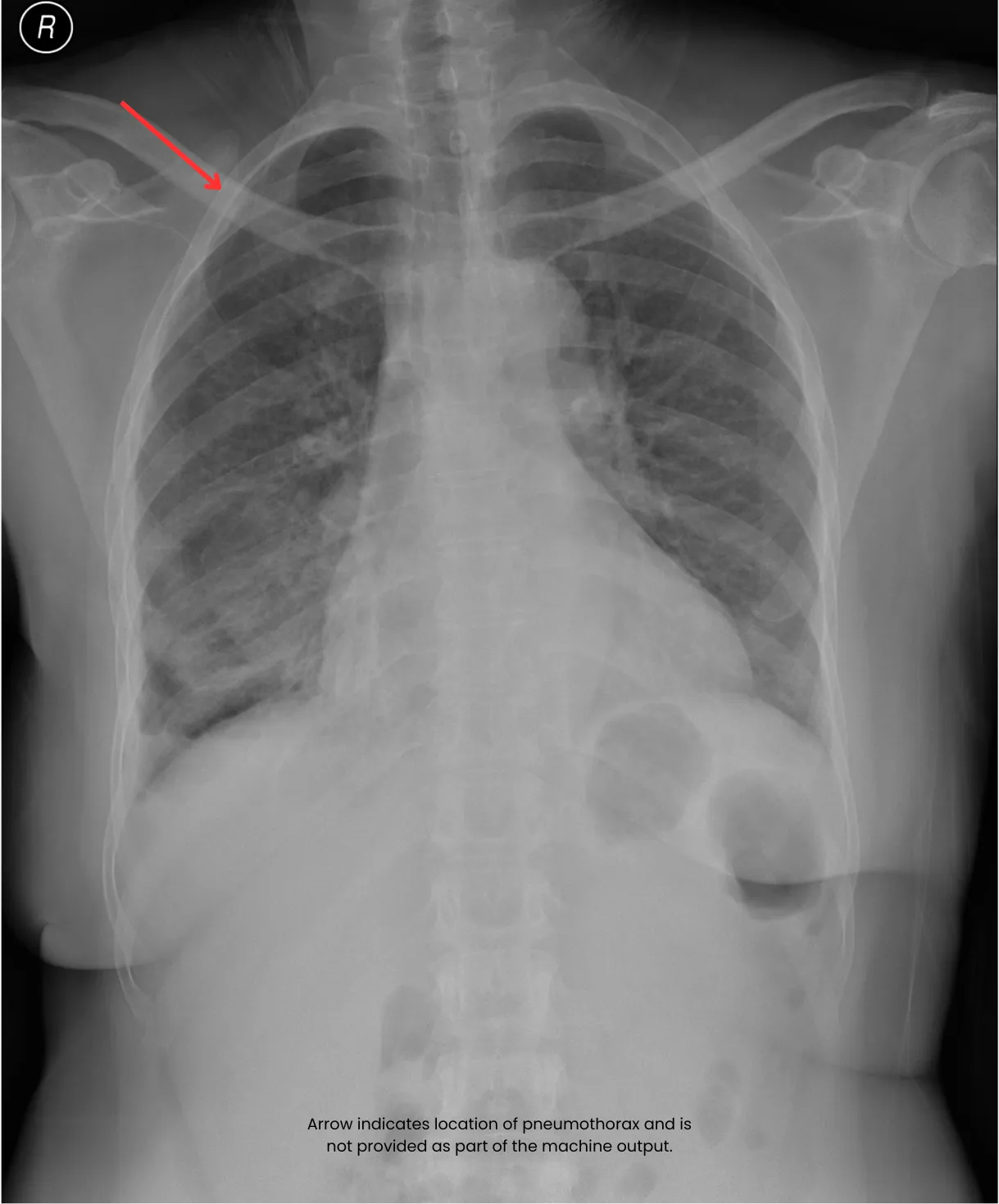 chest X-ray with pneumothorax diagnosis
