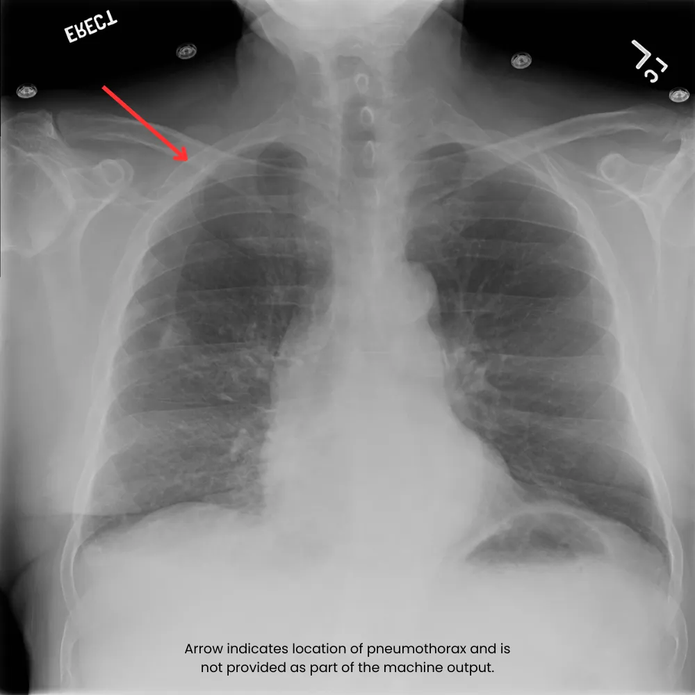 chest X-ray with pneumothorax diagnosis