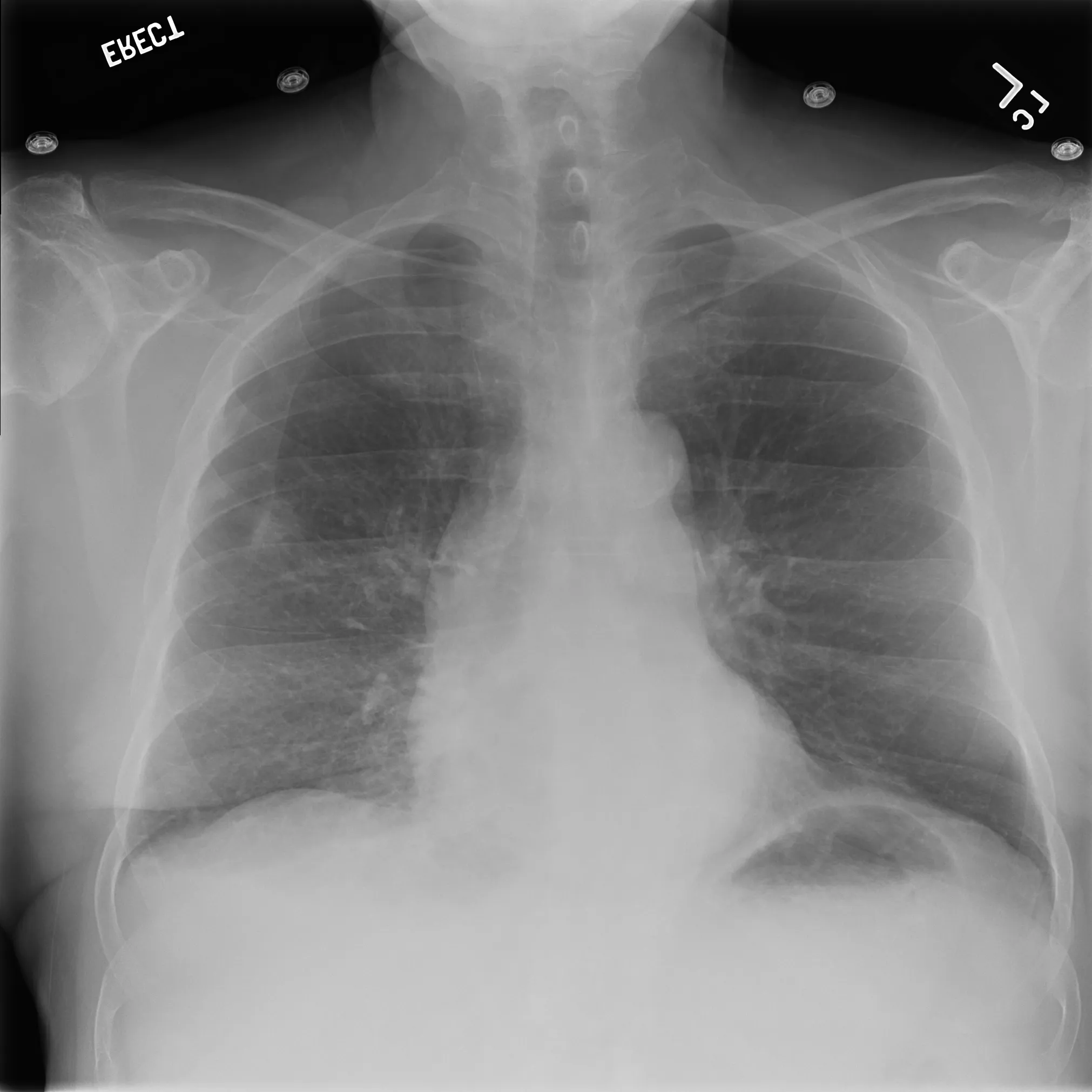 chest x-ray with pneumothorax diagnosis