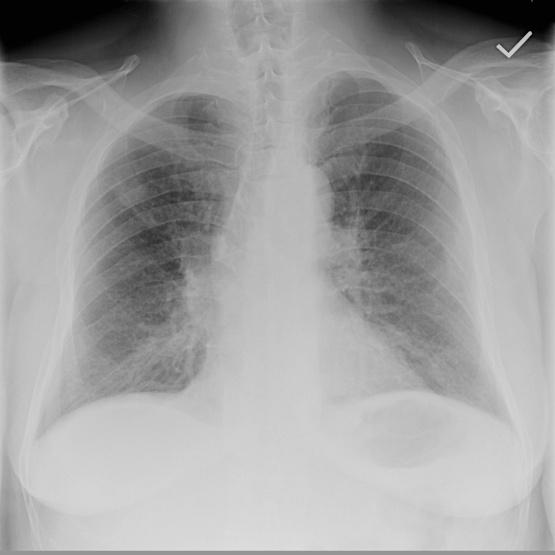 Original chest x-ray