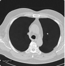 ClearRead CT product screenshot displaying AI-processed axial chest CT at mediastinal window, demonstrating Riverain Technologies automated image enhancement capabilities.