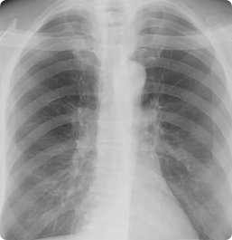 Chest X-ray showing bilateral lung fields and cardiac silhouette, demonstrating imaging analyzed by Riverain Technologies ClearRead Xray solutions.