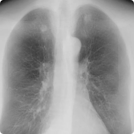 Standard frontal chest radiograph displaying thoracic anatomy, the type of imaging enhanced by Riverain Technologies ClearRead Xray bone suppression.