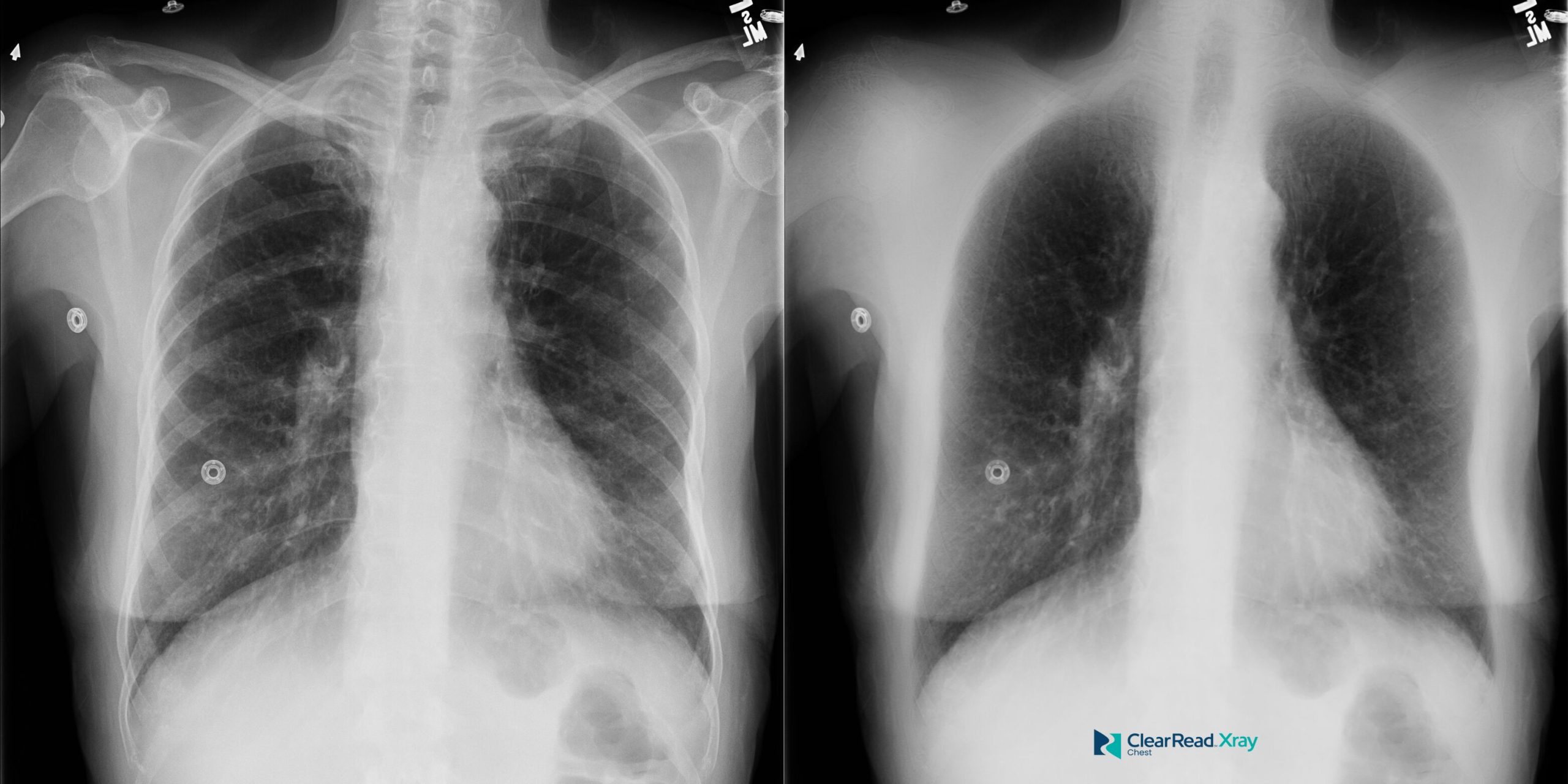 ClearRead Xray bone-suppressed chest radiograph pair with AI processing indicators, showing the initial step in the automated ClearRead Xray enhancement workflow.