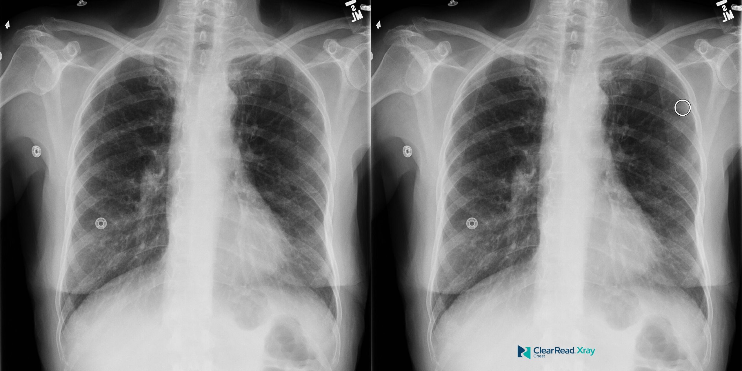 ClearRead Xray paired PA chest radiographs showing original and bone-suppressed views with annotation measurement points for detailed diagnostic evaluation.