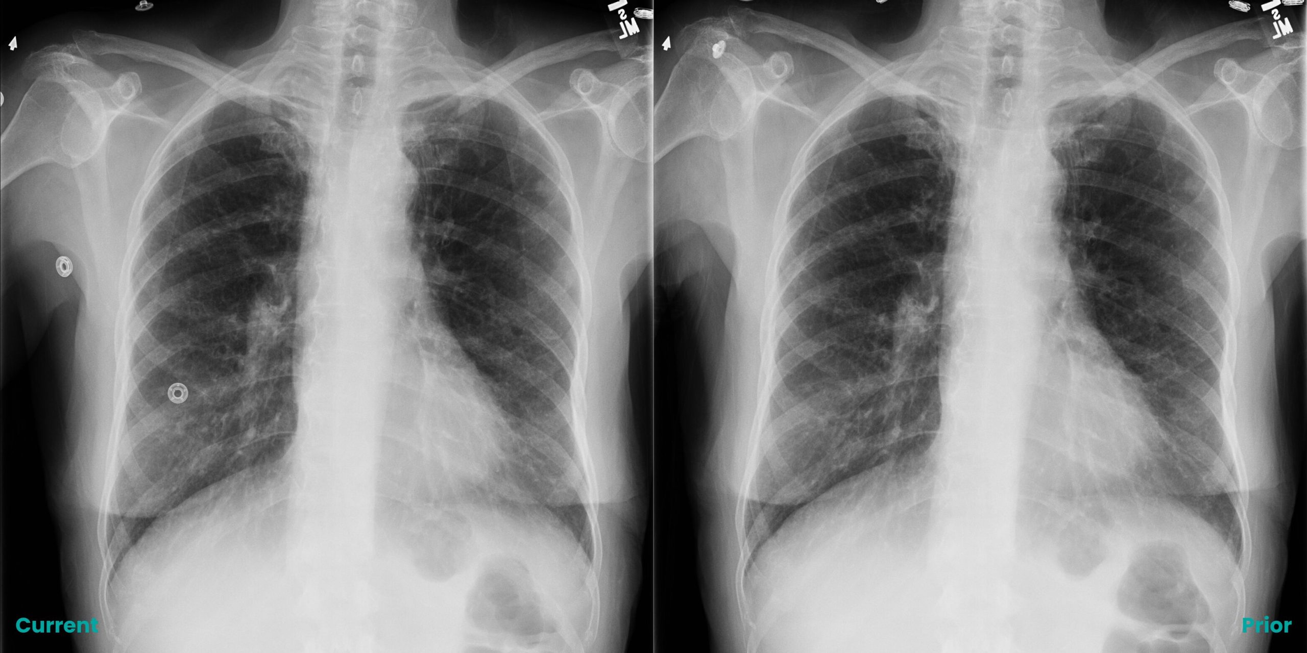 ClearRead Xray Compare module displaying current and prior bone-suppressed chest radiographs with labeled temporal indicators for longitudinal diagnostic assessment.