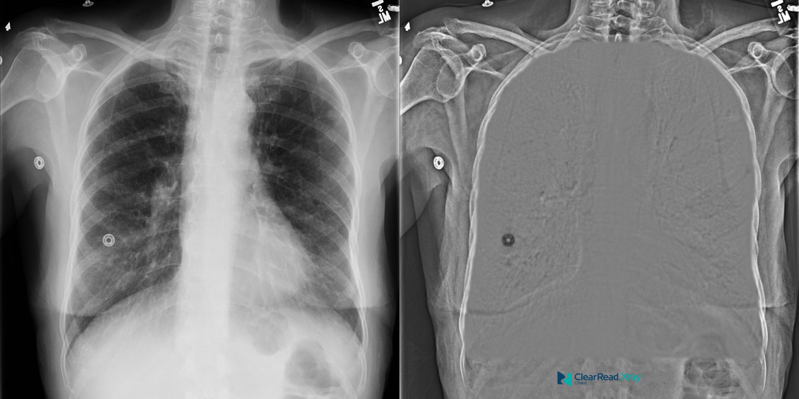 ClearRead Xray multi-modality display combining chest radiograph with CT scout view and shoulder coronal reconstruction for comprehensive thoracic and musculoskeletal assessment.