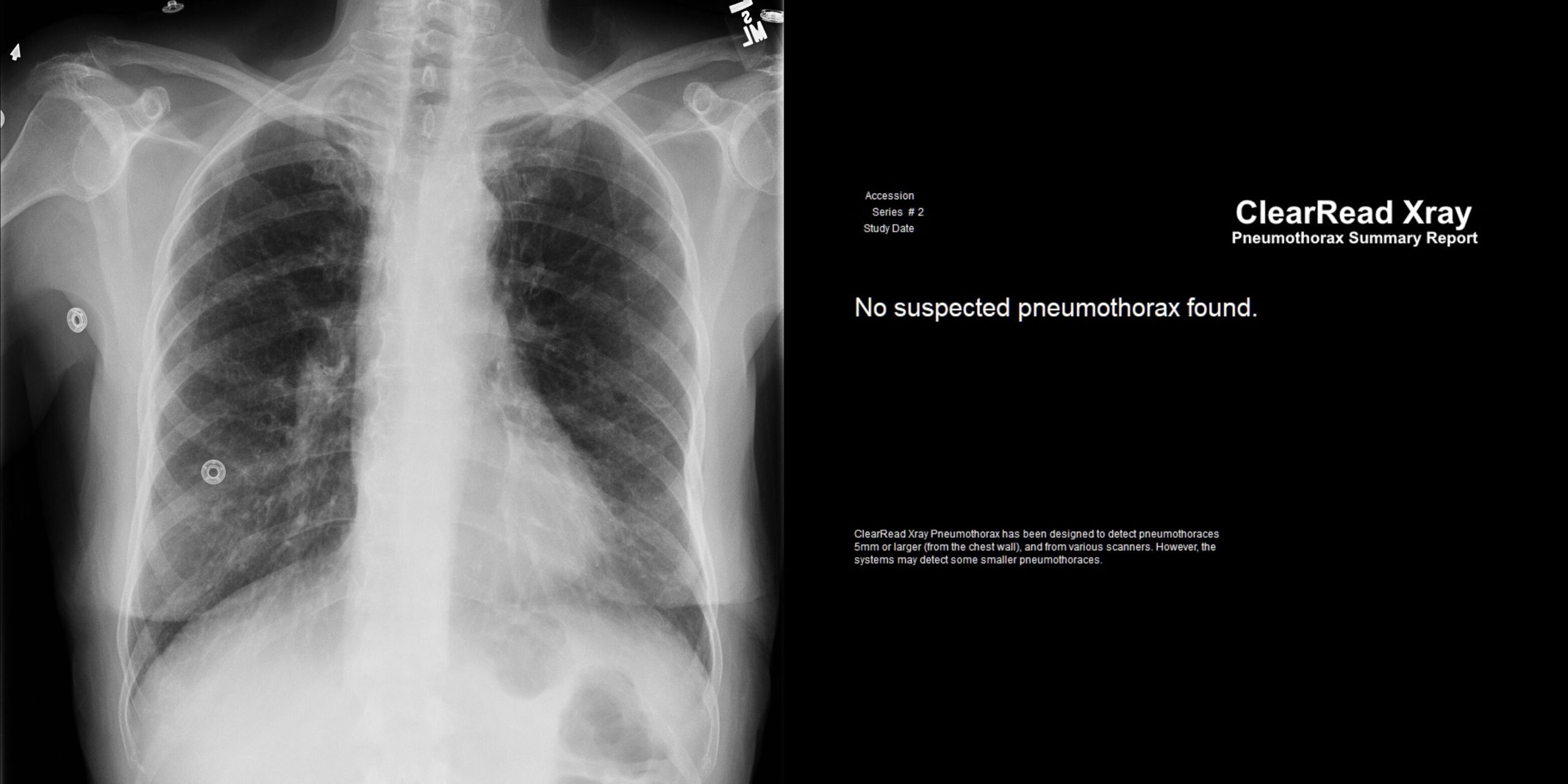 ClearRead Xray Pneumothorax Summary Report with AI-processed chest radiograph confirming no suspected pneumothorax, supporting rapid critical finding triage in emergency settings.