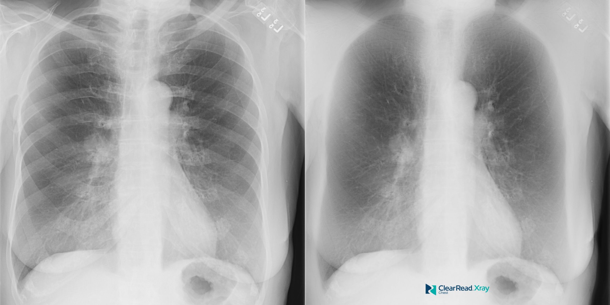 ClearRead Xray workflow display showing an original PA chest radiograph alongside bone-suppressed and coronal CT views for multimodal diagnostic assessment.