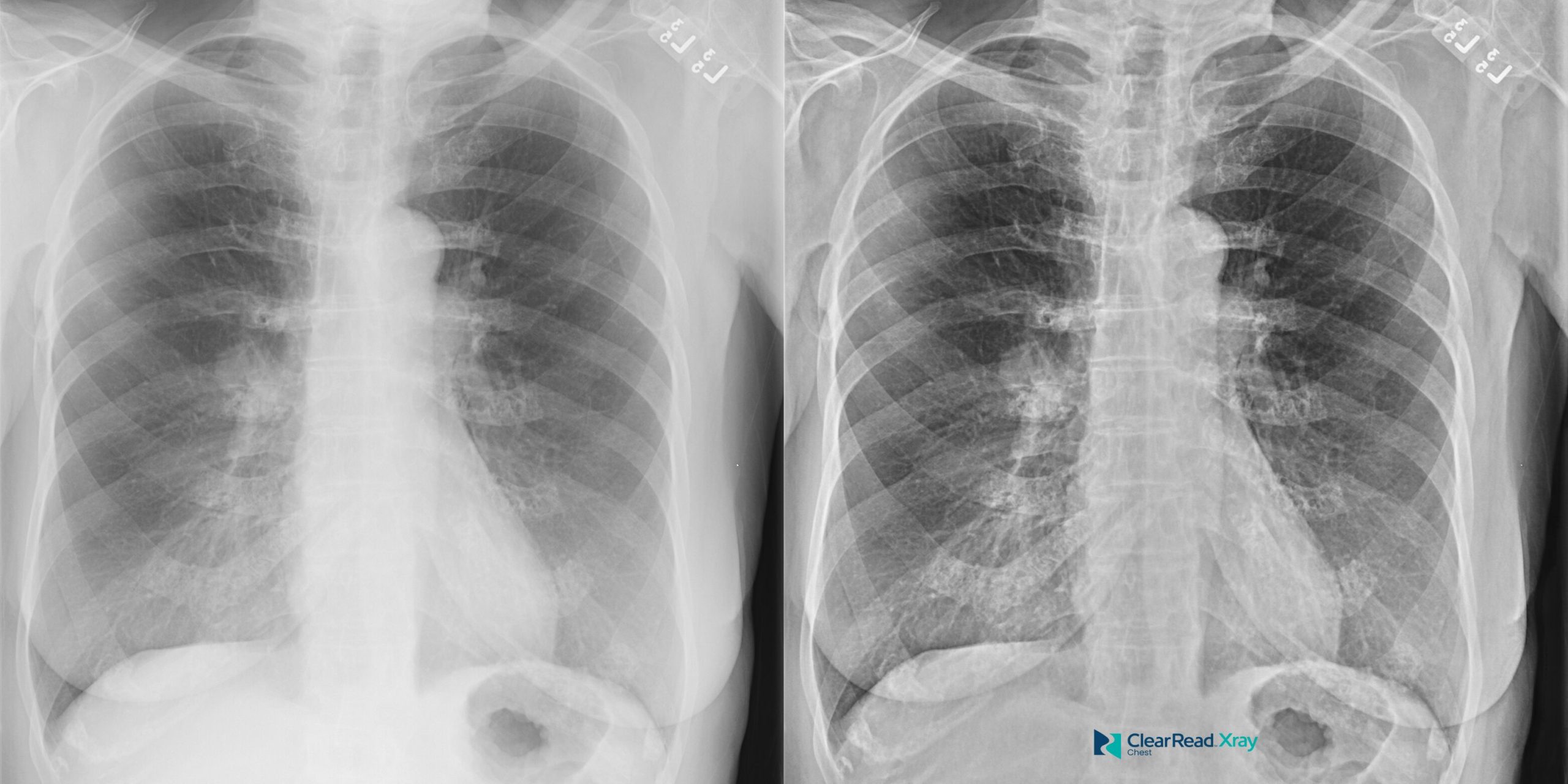 ClearRead Xray paired PA chest radiographs displaying original and bone-suppressed views, illustrating AI-powered rib removal for improved lung pathology detection.