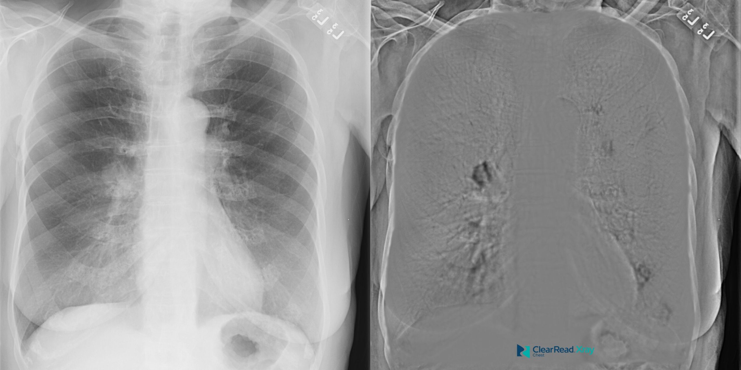 ClearRead Xray bone-suppressed chest radiograph with 3D volumetric visualization overlay, demonstrating the software's ability to enhance soft tissue visibility in thoracic imaging.
